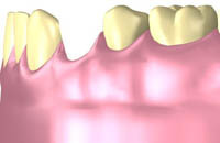 Implantate gehören zu den spannendsten Entwicklungen der modernen Zahnheilkunde (Grafik 1)