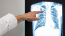 Ein Arzt zeigt auf das Röntgenbild einer Lunge. Foto: Silas Stein/dpa