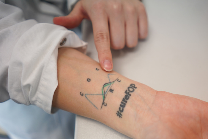 Nadine Großmann zeigt auf ihr Handgelenk-Tattoo, auf dem der Gen-Defekt 