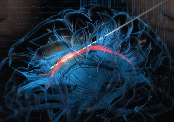 Die undatierte Computersimulation zeigt, wie eine Elektrode in die Gürtelwindung (Teil des Gehirns) eingeführt wird. Foto: Bijanki et al, J. Clin. Invest./Courtesy Of American Society For Clinical Investigation/dpa