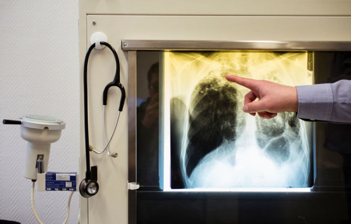 Ein Arzt zeigt in seinem Büro im Tuberkulosezentrum Berlin-Lichtenberg auf das Röntgenbild eines Tuberkulose-Patienten. Foto: Gregor Fischer/Dpa