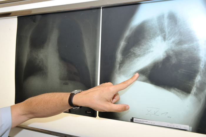  Der Leiter der Pneumologie (Lungenheilkunde) im Klinikum der Universität München zeigt auf ein Röntgenbild einer von Krebs befallenen Lunge. Archivfoto: epa/Felix Hörhager