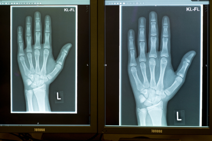 Die Röntgenbilder zeigen die linke Hand eines 15-Jährigen, aufgenommen am 12.01.2018 in einer Radiologischen Praxis in Friedrichshafen (Baden-Württemberg). Foto: dpa/Felix Kästle