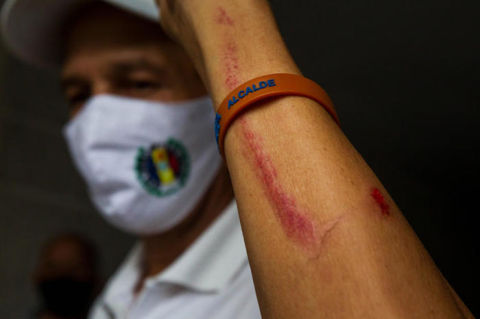Ein Unterstützer des Führers Bernabe Gutierrez von der venezolanischen Oppositionspartei Accion Democratica (AD) zeigt eine Wunde in den Einrichtungen der Partei. Foto: epa/Miguel Gutierrez