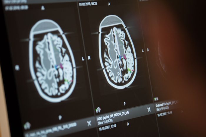 Auf einem Monitor werden Querschnitte von einem menschlichen Hirn angezeigt. Foto: Lino Mirgeler/dpa