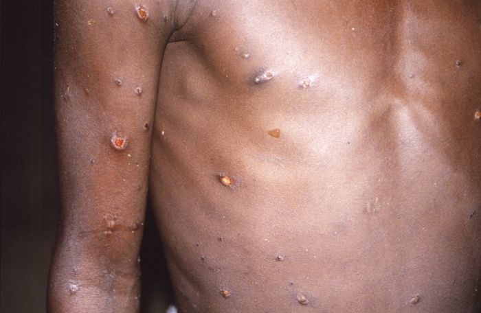 Dieses vom CDC zur Verfügung gestellte Bild aus dem Jahr 1997 zeigt den rechten Arm und den Oberkörper eines Patienten, dessen Haut eine Reihe von Läsionen aufwies, die auf einen aktiven Fall von Affenpocken zurückzuführen war... Foto: Uncredited