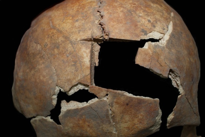 Die Nahaufnahme zeigt den Schädel mit der Trepanation. Menschen wurden einer Studie zufolge im östlichen Mittelmeerraum bereits in der späten Bronzezeit am Schädel operiert. Foto: Rachel Kalisher/dpa