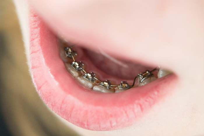 Eine Zahnspange als eine feste Spange, bei der die Brackets von innen auf den Zahn geklebt wurden. Foto: Franziska Gabbert/dpa-tmn/dpa
