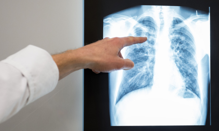 Ein Arzt zeigt auf das Röntgenbild einer Lunge. Foto: Silas Stein/dpa